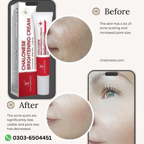 Dark Spot Removal Cream